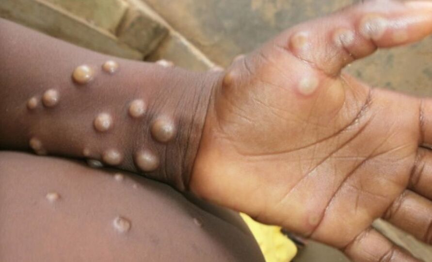 Transmissão local de varíola do macaco é confirmada no Rio
