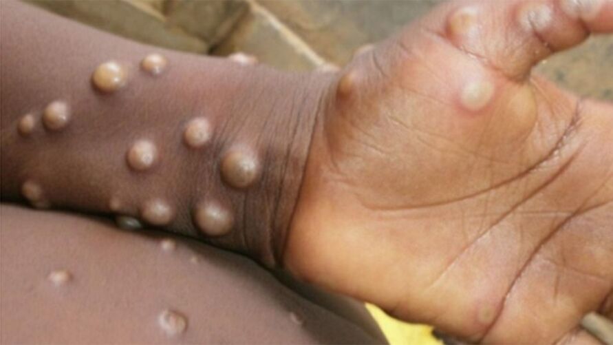 Japão emite alerta para surto de varíola dos macacos