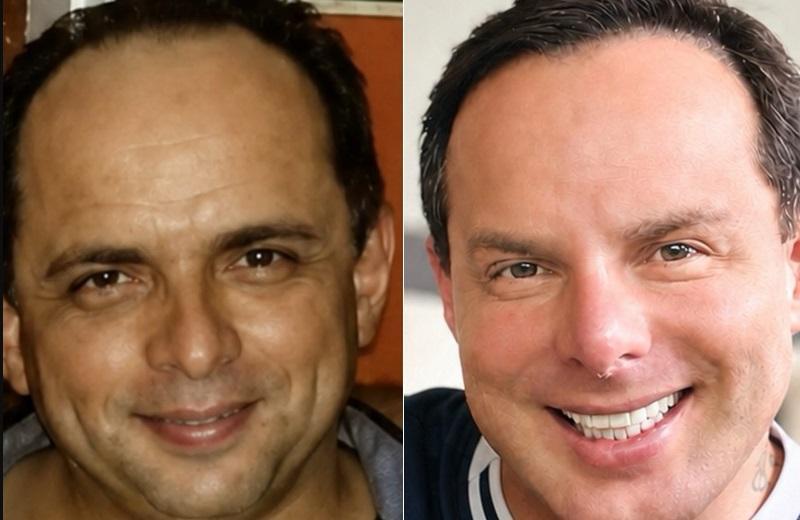Marido de Gretchen, paraense Esdhras de Souza, mostra antes e depois das plásticas